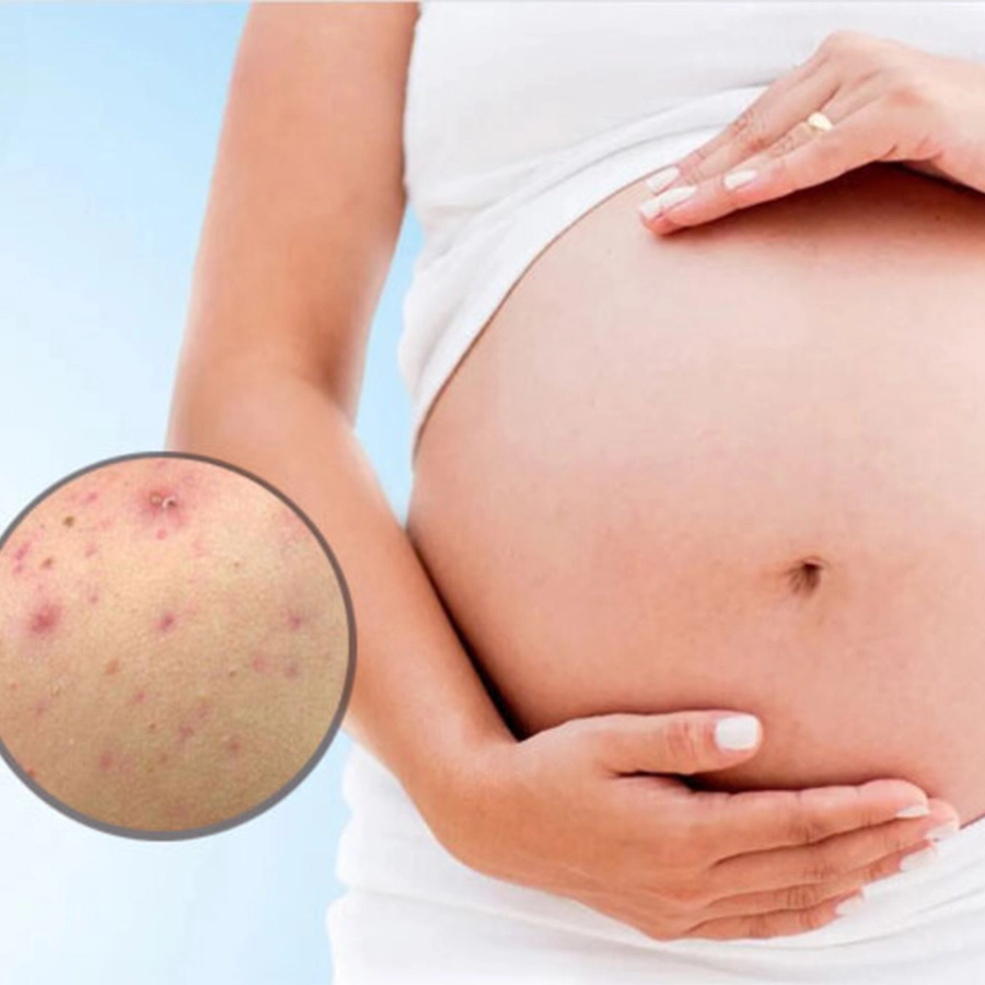 As mães grávidas têm acne nas costas: 6 causas e soluções